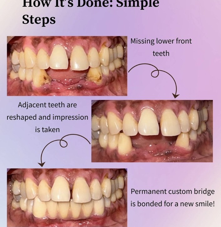 Illustrated sequence showing a missing-teeth case and dental bridge restoration
